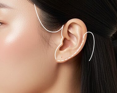 Facelift incision line