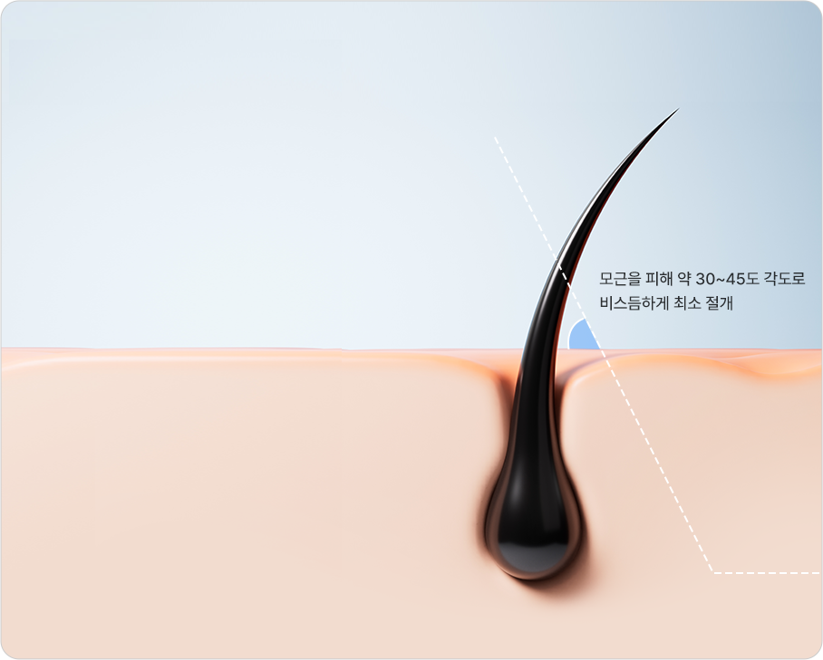 30–45 degree oblique incision that reduces hair loss concerns — minimal incision angled about 30–45 degrees to avoid hair roots