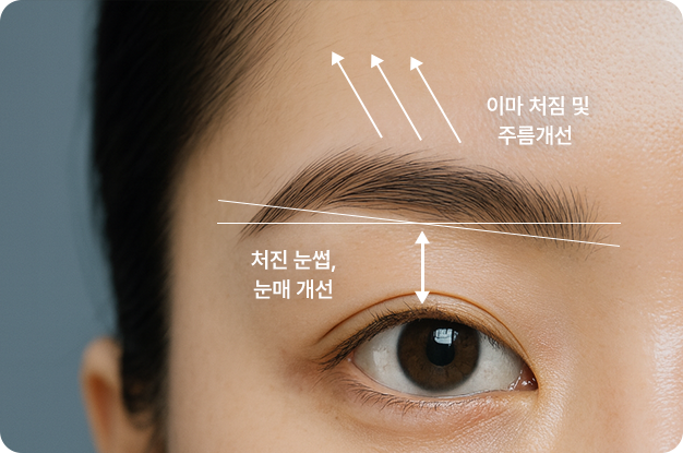 Improvement of forehead sagging and wrinkles · improvement of drooping eyebrows and eye area