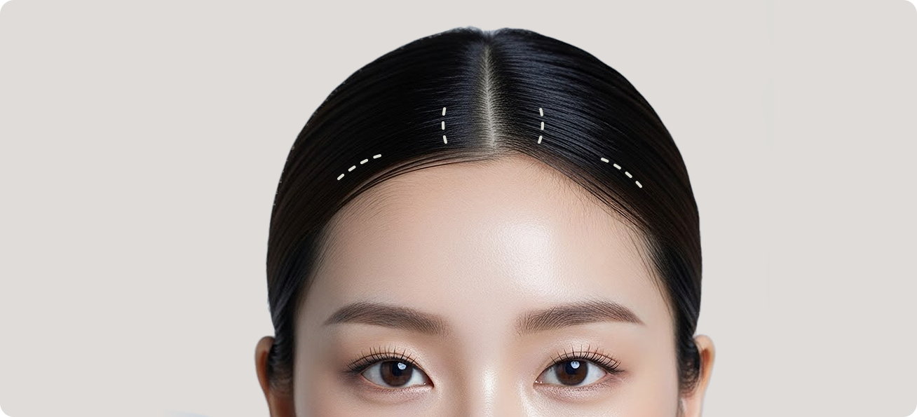 Minimal incision at 4 points inside the hairline
