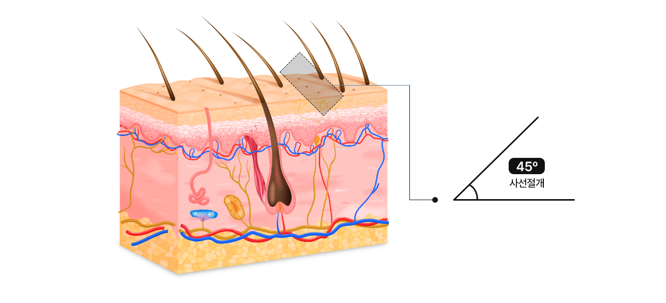 Scalp cross-section — 45º oblique incision