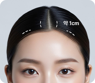 Minimal incision inside the hairline — about 1 cm