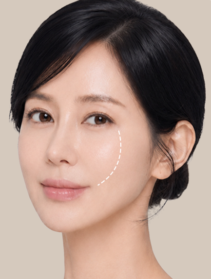 A Midface Lift That Changes Your Impression