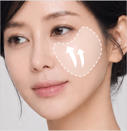 Midface Lifting