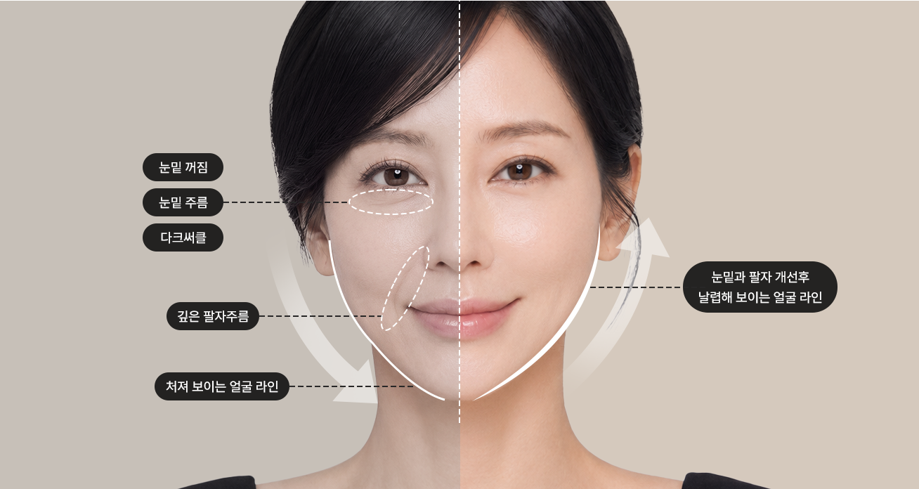Midface lift before and after — sunken under-eyes, under-eye wrinkles, dark circles, deep nasolabial folds, sagging facial line / sharper facial line after under-eye and nasolabial improvement