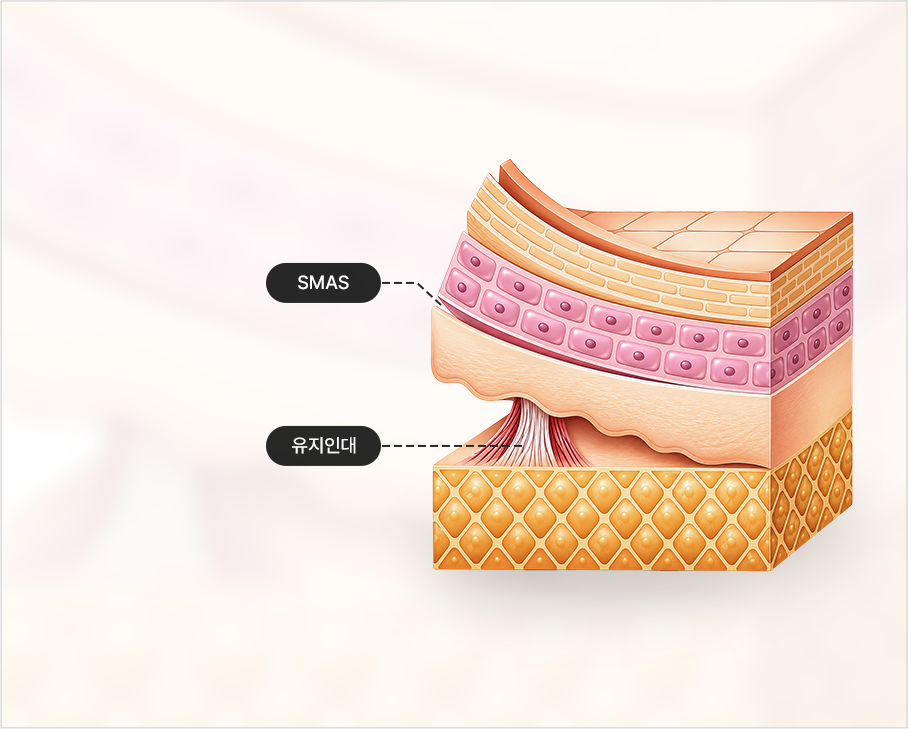 Cross-section illustration of SMAS and retaining ligament dissection (SMAS, retaining ligaments)