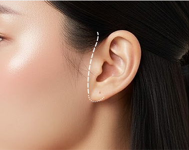 Mini Lift incision line