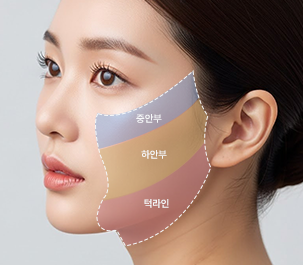 Retaining ligament and SMAS dissection area (midface, lower face, jawline)