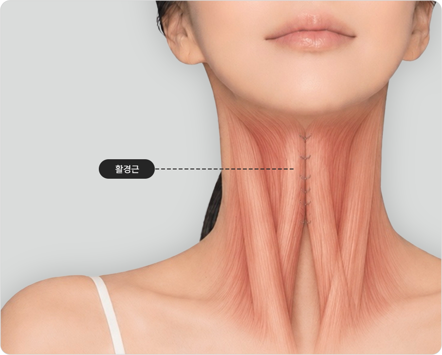 Precise neck muscle (platysma) correction — platysma
