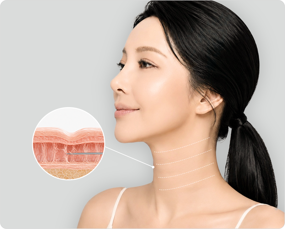 Detailed dissection down to adhesions of deep horizontal wrinkles (enlarged skin cross-section)