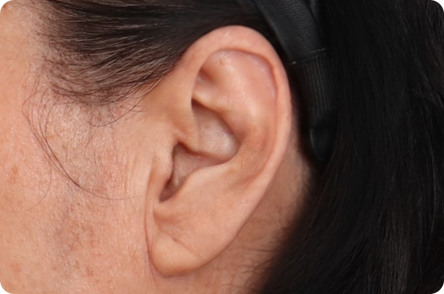 Ear before neck lift