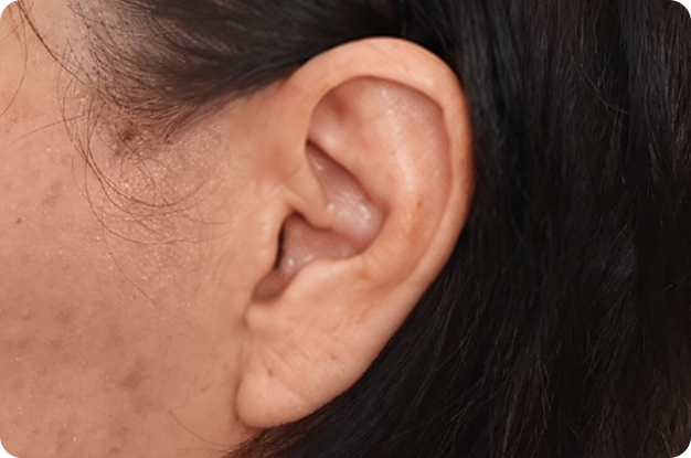 Ear 2 weeks after neck lift