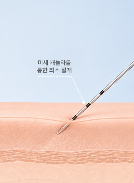 Minimal incision through a micro cannula