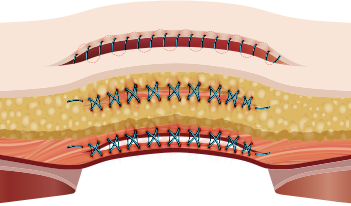 Triple-Layer Suturing
