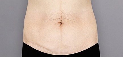 Before Surgery