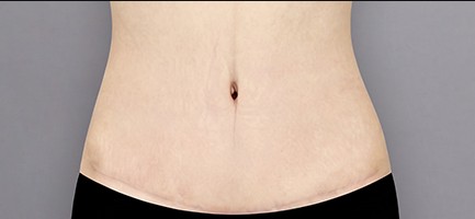 6 months after surgery
