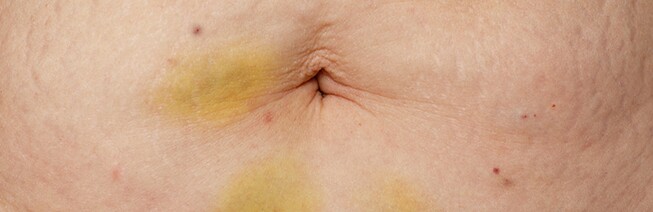 Standard Liposuction