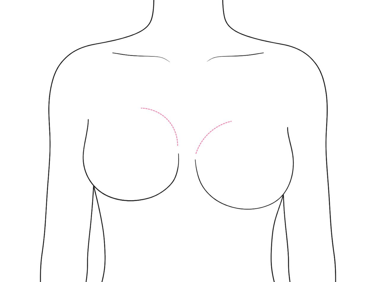 Capsular Contracture