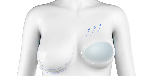 Mastopexy and implant insertion