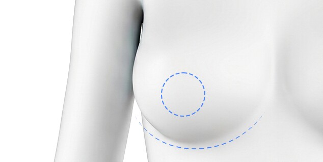 Scar-minimizing incision method