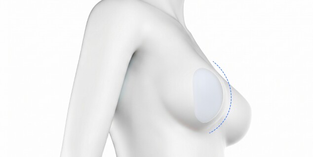 Breast Lift