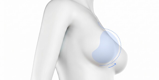 Volume Breast Lift