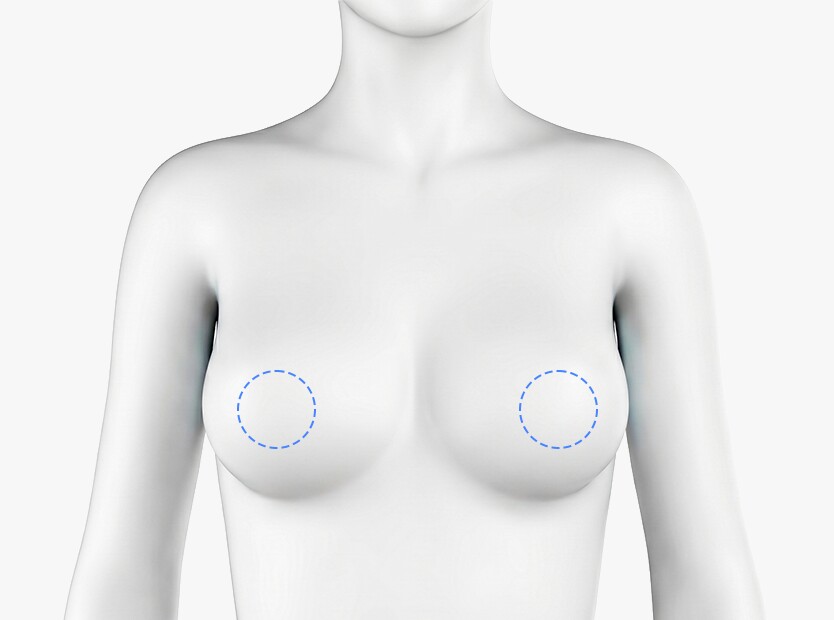 Periareolar Incision