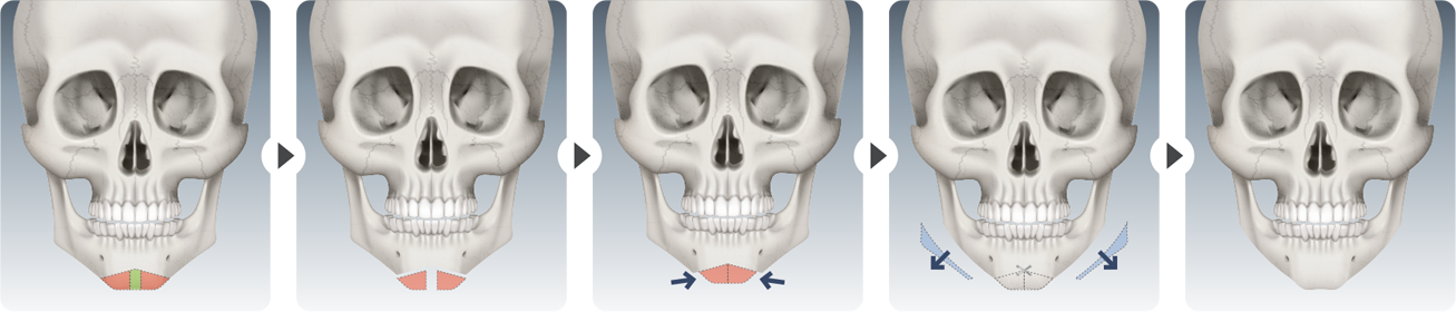 CASE 01 surgical steps