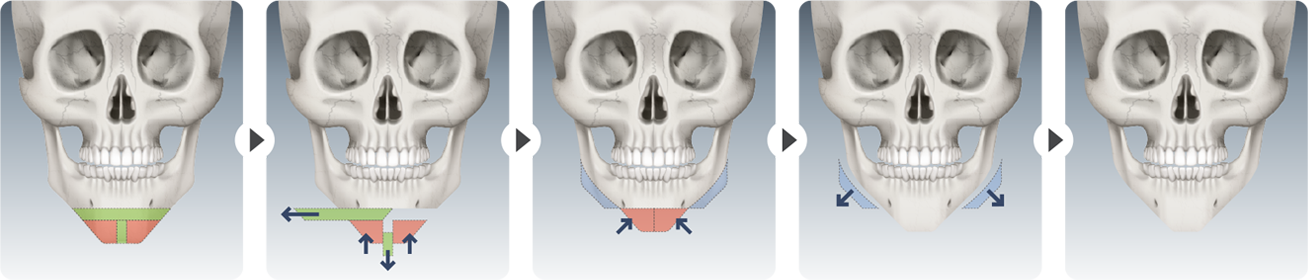 CASE 02 surgical steps