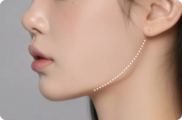 Square Jaw Resection