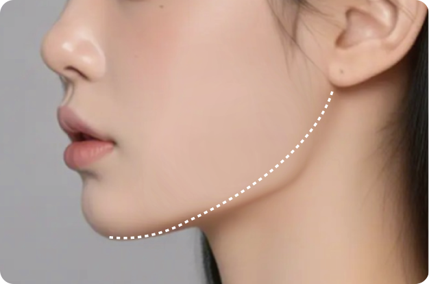 Long Curved Resection
