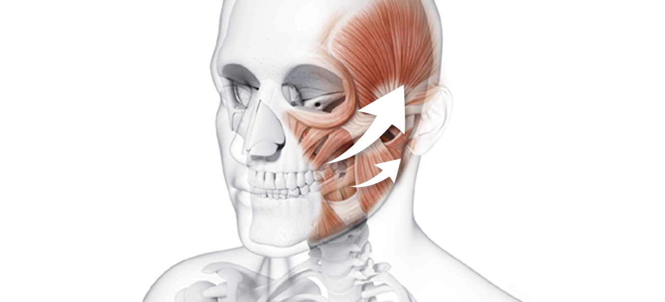 Upward fixation of the SMAS layer — sagging-prevention contour fixation