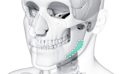 Cortical Bone Removal