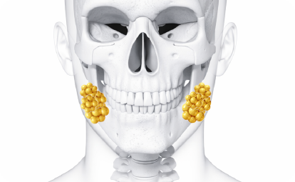 Buccal Fat Removal