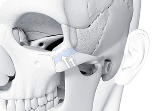 Cheekbone Area Reduction