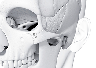 Gap-Free Precise Fixation