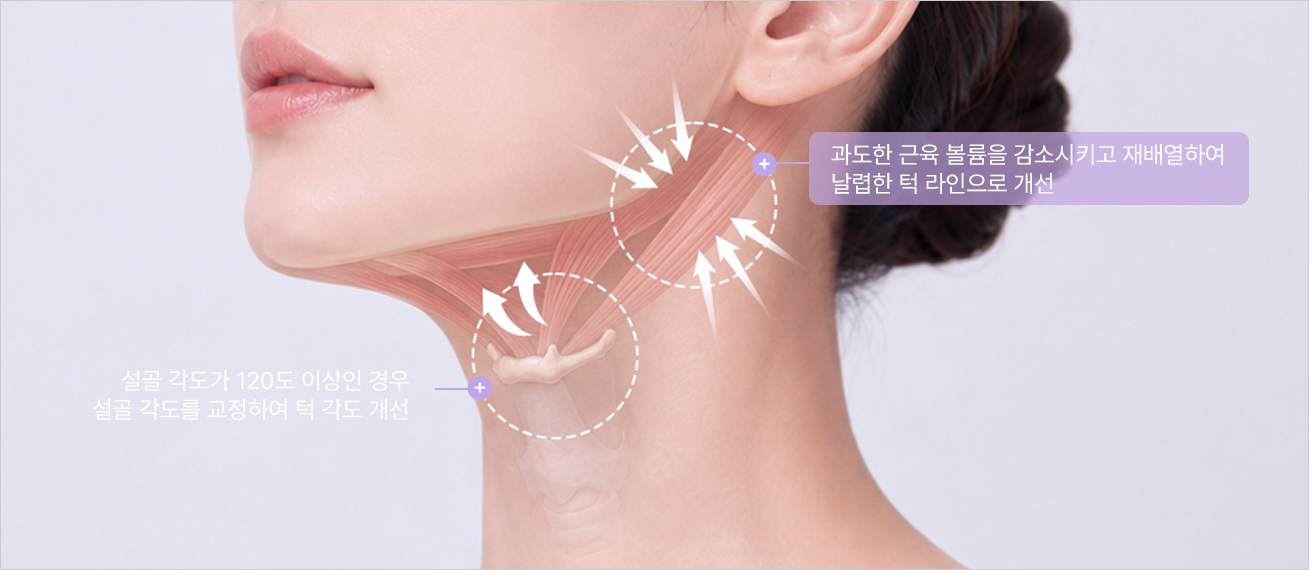 Hyoid and digastric improvement illustration — excessive muscle volume is reduced and realigned for a sharp jawline / when the hyoid angle is 120 degrees or more, it is corrected to improve the jaw angle