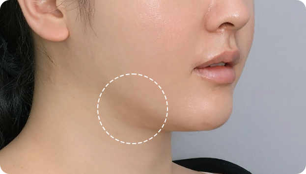 When sagging salivary glands look bulging