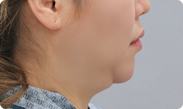 Before Surgery
