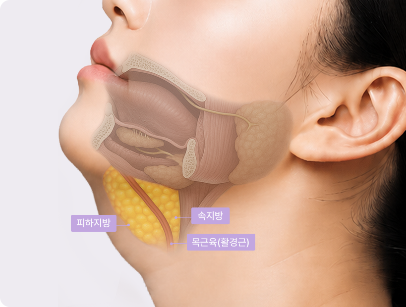 Toad Neck stage 1 cross-section — subcutaneous fat, deep fat, neck muscle (platysma)