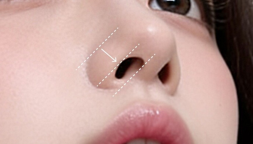 When only the alae are reduced and the nostrils are overly exposed