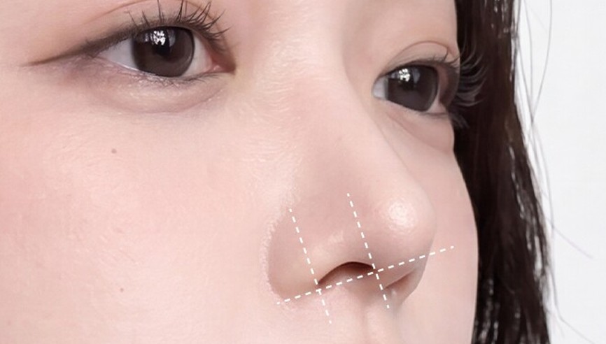 Correcting the nostrils together for natural proportions