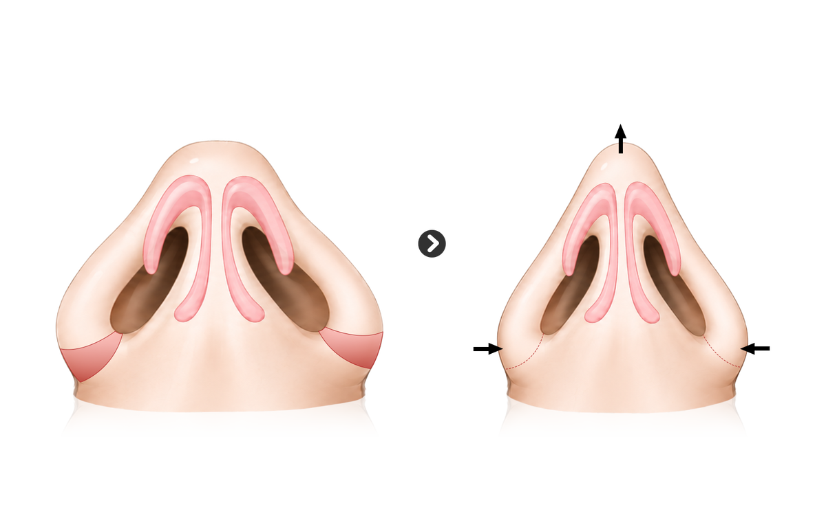 When the nostrils are large and the alae are thin