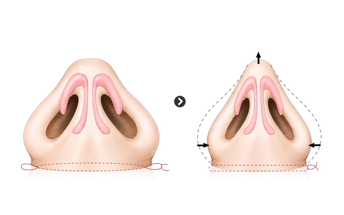 When the alae are fleshy and the columella is wide