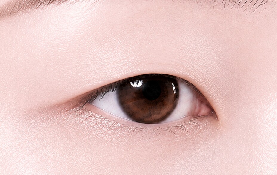 Before canthoplasty