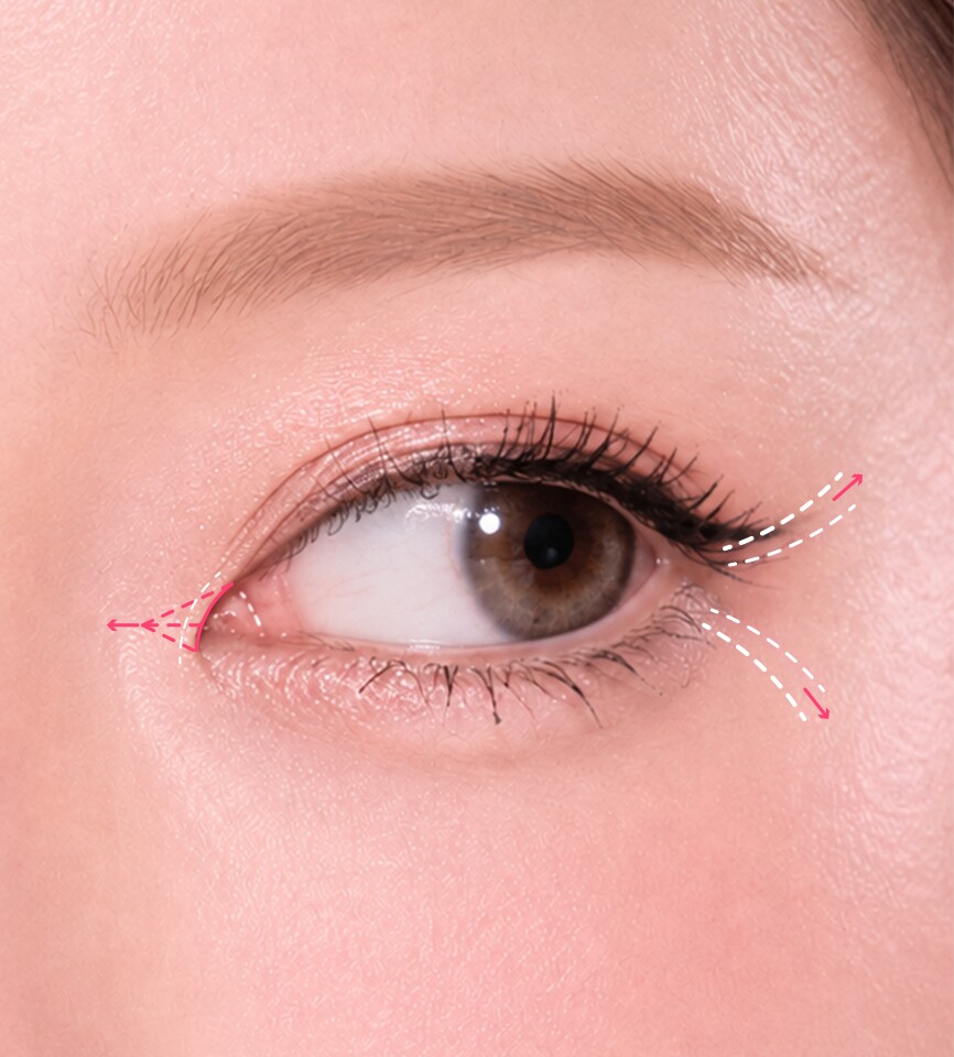 Eye extension