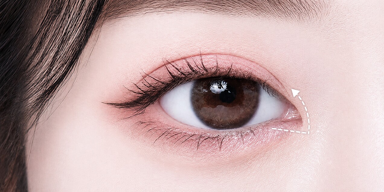 Medial canthoplasty