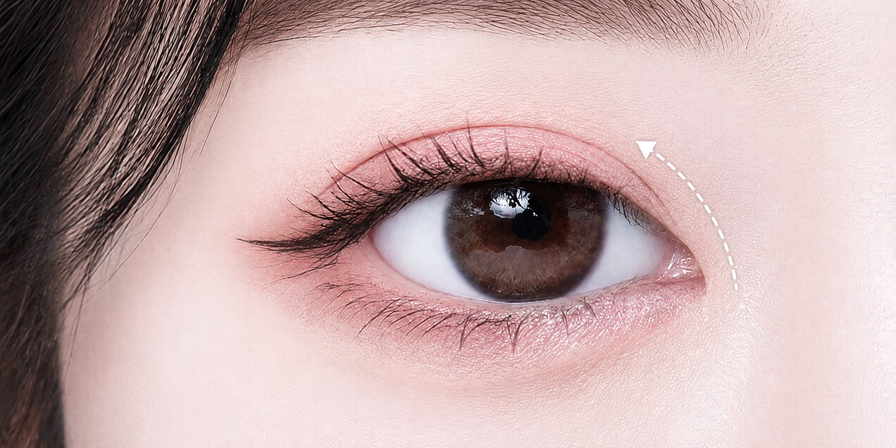 Upper canthoplasty