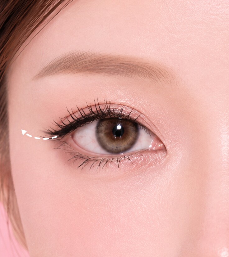 Lateral Canthoplasty