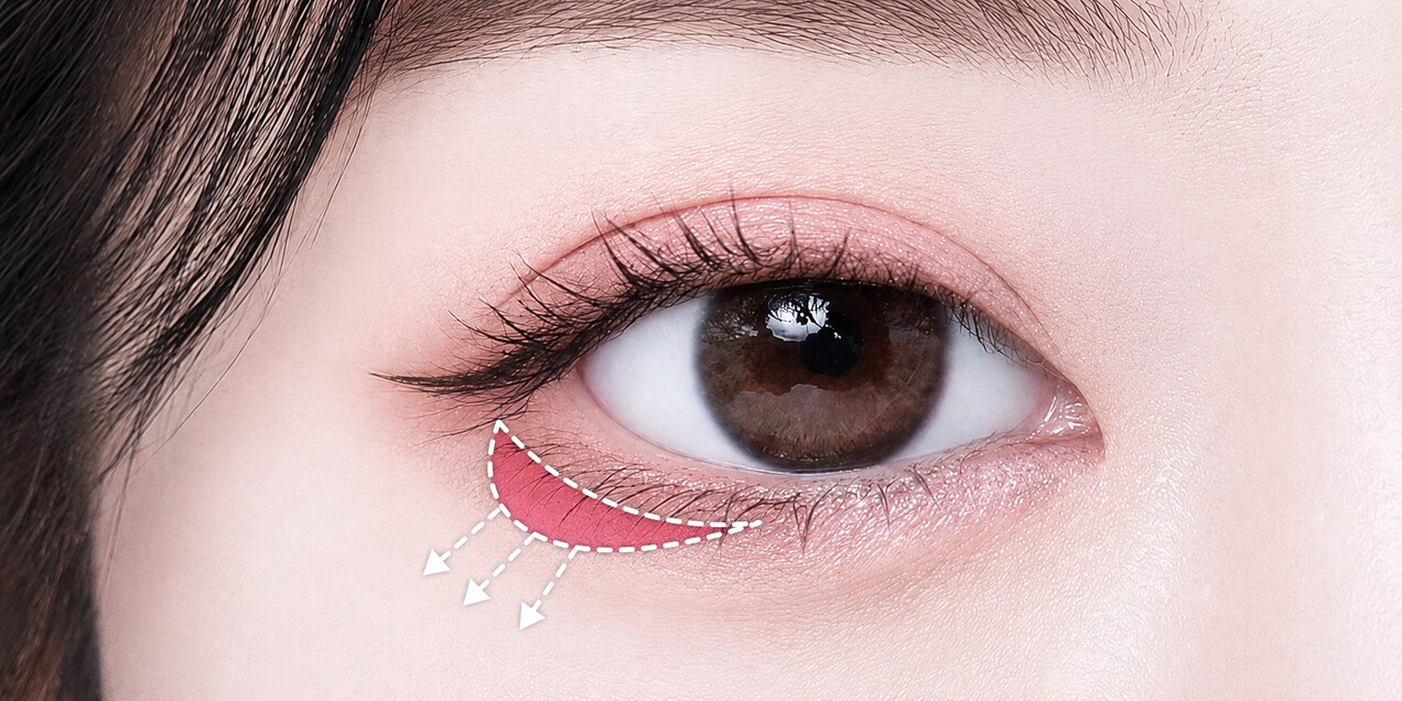 Lower canthoplasty: vertical height extension